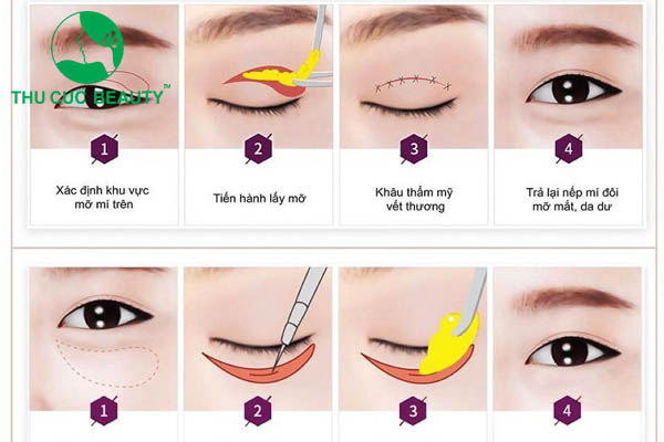 Lấy mỡ mí mắt giá bao nhiêu? - Bệnh viện Thẩm mỹ Thu Cúc
