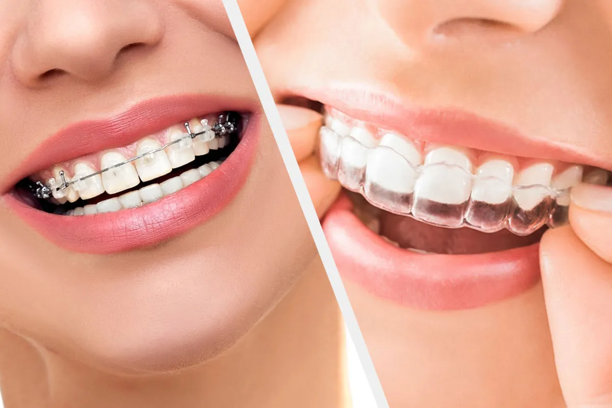 Braces Orthodontist in RR Nagar – Site Title