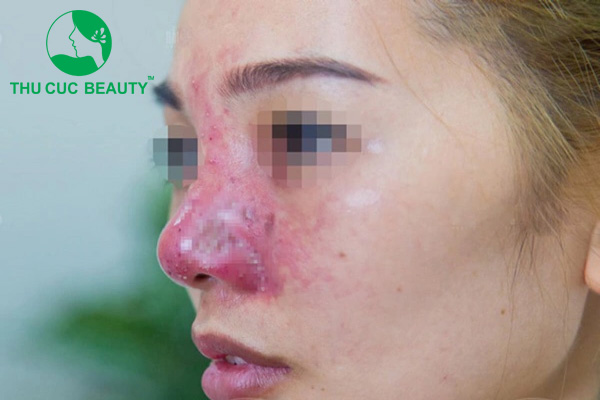 Nâng mũi bị nhiễm trùng: Nguyên nhân và cách khắc phục - Bệnh viện Thẩm mỹ Thu Cúc