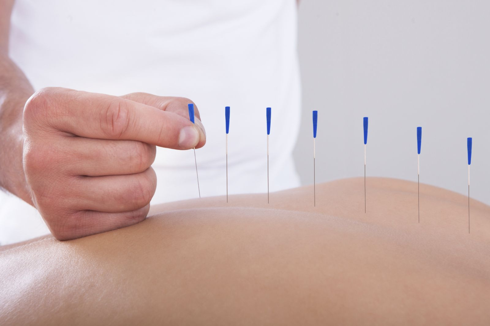 Acupuncture Calgary South | Acupuncture Services in Calgary
