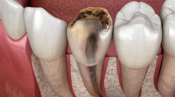 Lấy Tủy Răng Bao Nhiêu Lần Mới