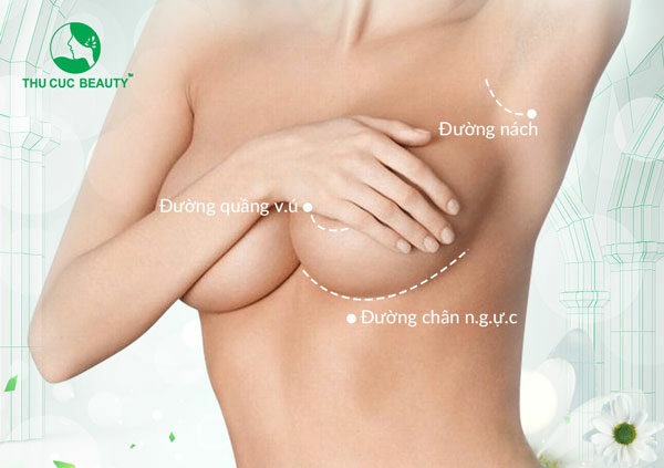 Nên nâng ngực đường nào? Các đường nâng ngực cần biết - Bệnh viện Thẩm mỹ Thu Cúc