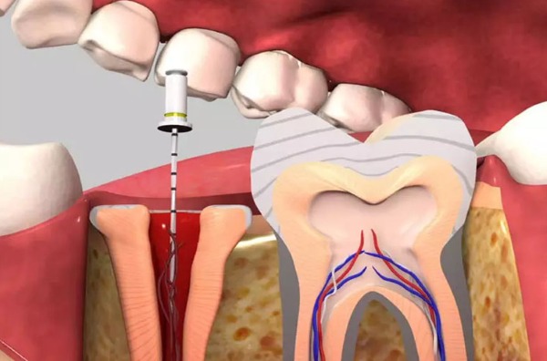 Tại Sao Lấy Tủy Răng Nhiều Lần Mới Xong? Giải Mã Quy Trình