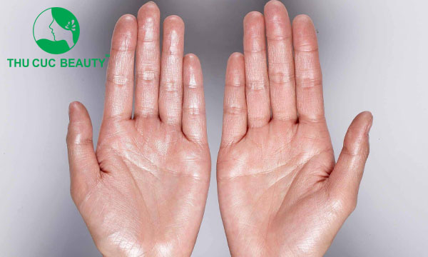 Tiêm botox trị tăng tiết mồ hôi là gì? Có hiệu quả không?  - Bệnh viện Thẩm mỹ Thu Cúc