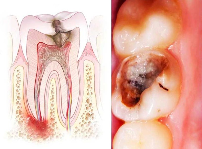 Lấy Tủy Lại: Khi Nào Răng Cần