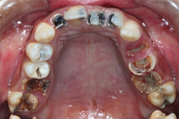 Khi Nào Cần Nhổ Răng Sâu? 5 Tác Hại Của Việc Không Nhổ Răng Sâu