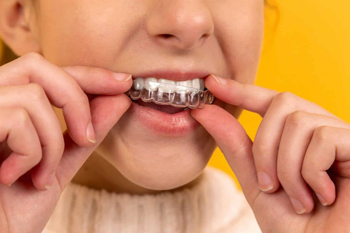 Straighten Your Smile Discreetly: Discover Aligners at Kansal Dental Clinic | by Global Learning | Jul, 2025 | Medium