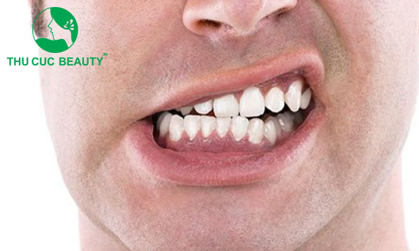Tiêm botox trị nghiến răng và những điều cần biết - Bệnh viện Thẩm mỹ Thu Cúc