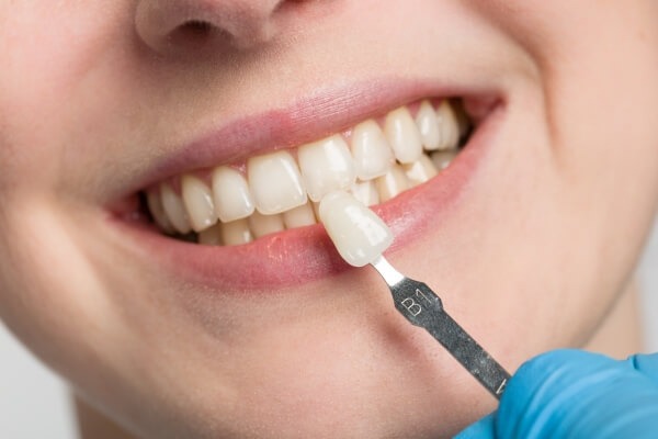 Dán Sứ Veneer 2 Răng Cửa Có Tốt Không? Giá Bao Nhiêu?