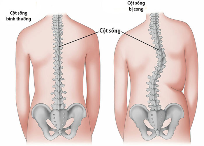Cách nhận biết đau lưng do thoát vị đĩa đệm chính xác nhất