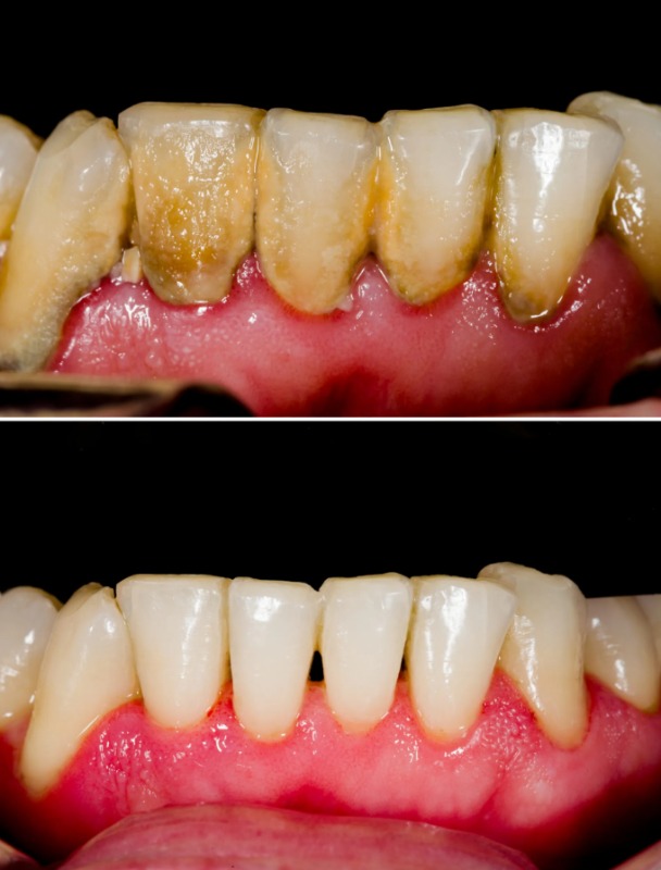 Hướng Dẫn Cách Chăm Sóc Răng Sau Khi Cạo Vôi: Giảm Ê Buốt, Răng Sạch Khỏe Bền Lâu