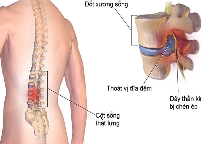 Đai lưng thảo dược có giúp người bị thoái hóa đốt sống giảm đau không?