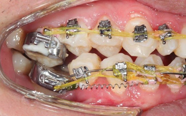 4 Nguyên Nhân Thường Gặp Khiến Việc Niềng Răng Thất Bại