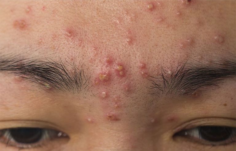 Mặt mụn có nên dùng kem chống nắng không? Giải đáp từ A-Z và gợi ý sản phẩm phù hợp