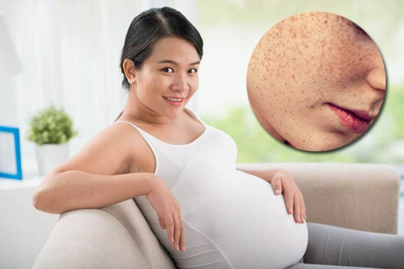 Mẹ bầu bị thâm nám phải làm sao? Giải pháp thiên nhiên an toàn cho làn da rạng rỡ!