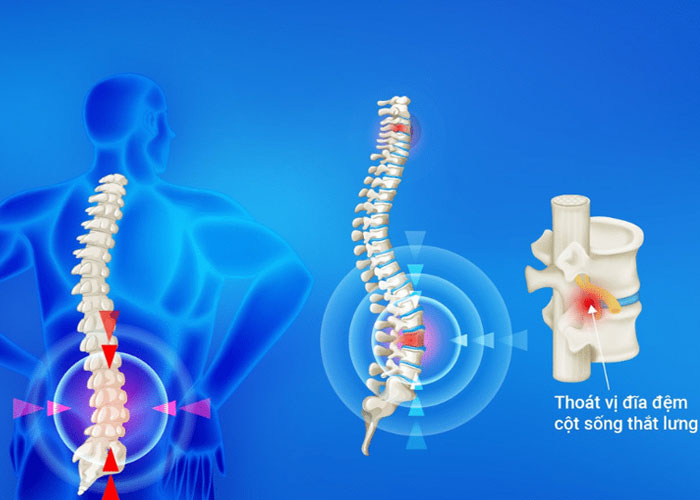 Thoát vị đĩa đệm có chữa được không? Điều trị bằng cách nào?