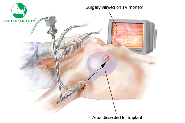 Nâng ngực nội soi là gì? Có nên nâng ngực nội soi không? - Bệnh viện Thẩm mỹ Thu Cúc