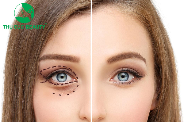 Có nên cắt da thừa mí mắt không? Ai nên cắt da thừa mí mắt? - Bệnh viện Thẩm mỹ Thu Cúc