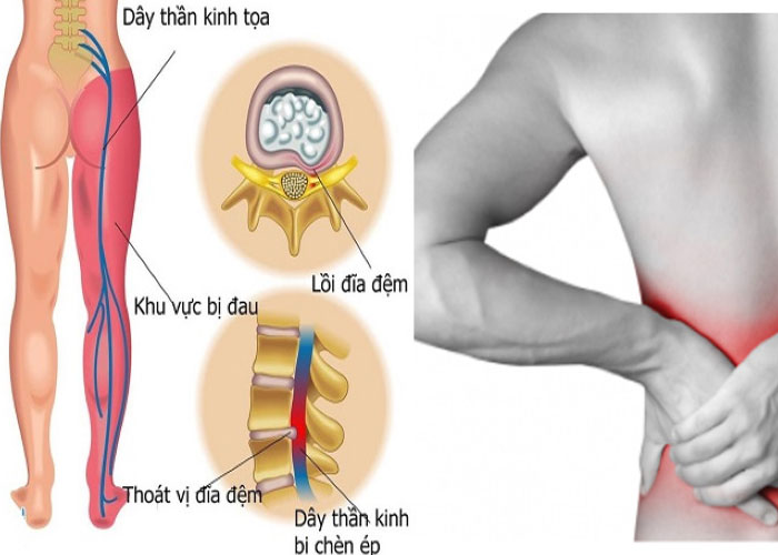 Thoát vị đĩa đệm L4 L5 có chữa được không