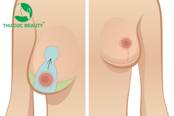 Treo ngực sa trễ đường mỏ neo là gì? Có để lại sẹo không? - Bệnh viện Thẩm mỹ Thu Cúc
