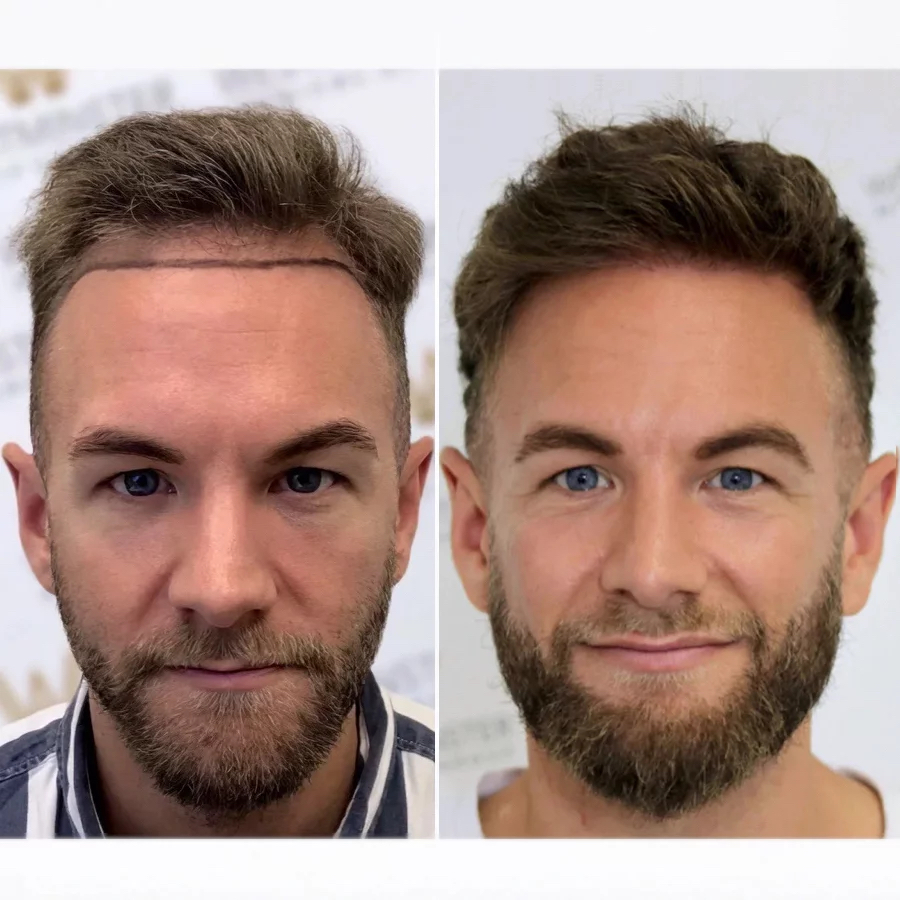 Hair Transplant Cost London, UK | Westminster Medical Group®