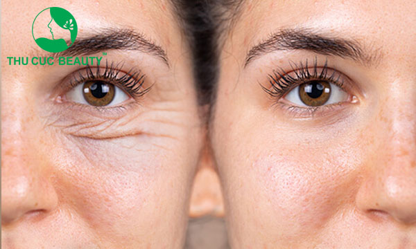 Cắt da thừa mí dưới có để lại sẹo không? - Bệnh viện Thẩm mỹ Thu Cúc