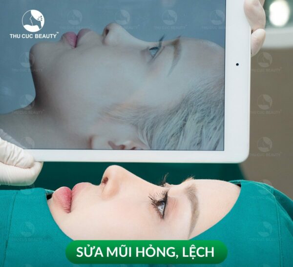 Trường hợp nào cần sửa mũi sau khi nâng?  - Bệnh viện Thẩm mỹ Thu Cúc