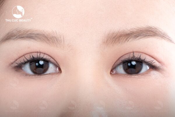 Cắt mí bao lâu thì hết sẹo? Làm sao để sẹo cắt mí nhanh lành? - Bệnh viện Thẩm mỹ Thu Cúc