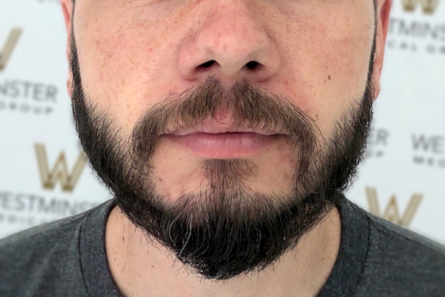 FUE Beard Transplant London | Westminster Medical Group®