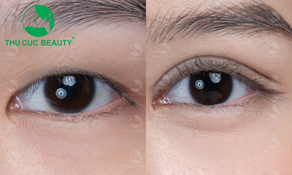 Cắt mí mắt có được vĩnh viễn không? - Bệnh viện Thẩm mỹ Thu Cúc