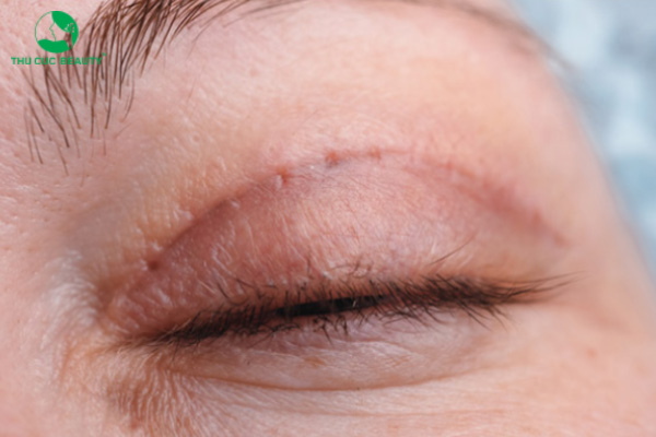 Cắt mí rồi có cắt lại được không? Cần lưu ý những gì? - Bệnh viện Thẩm mỹ Thu Cúc