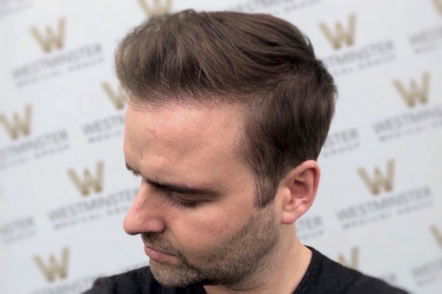 FUT Hair Transplant London | Westminster Medical Group®
