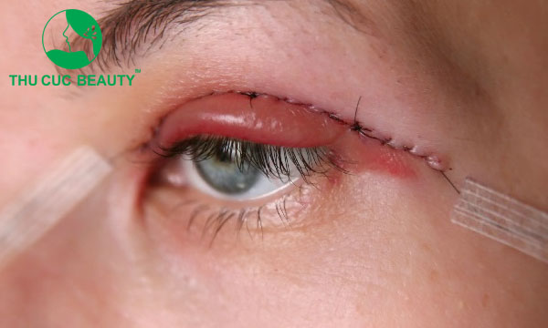 Cắt mí bao lâu hết sưng? Cách giảm sưng hiệu quả sau cắt mí - Bệnh viện Thẩm mỹ Thu Cúc