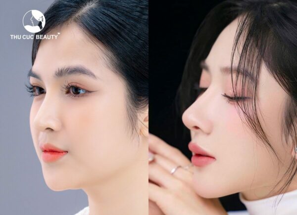 Các dáng mũi đẹp hiện nay, nâng mũi ở đâu uy tín? - Bệnh viện Thẩm mỹ Thu Cúc