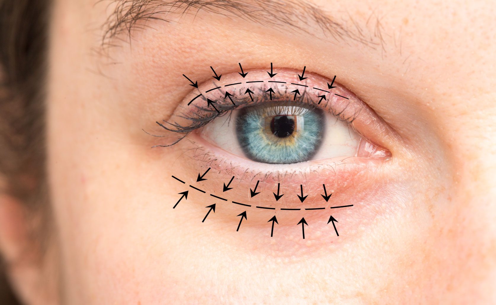 Blepharoplasty South Africa: What International Patients Need to Know Before They Book - 100% Free Guest Posting Website