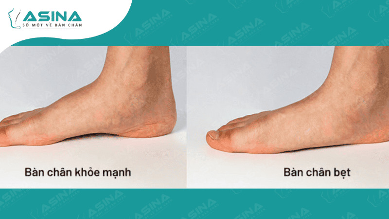 Bàn chân bẹt là gì? Nguyên nhân, tác hại và cách điều trị