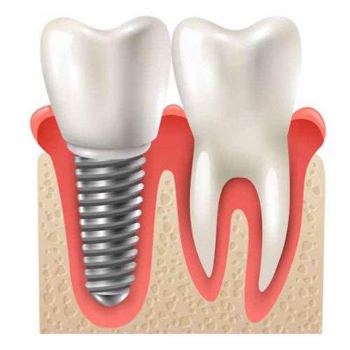 Dental Implants in Ajman | Trusted Implant Specialist