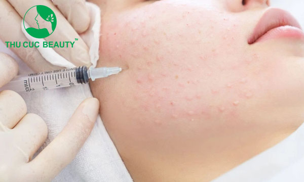 Nên tiêm Meso hay tiêm Filler? - Bệnh viện Thẩm mỹ Thu Cúc