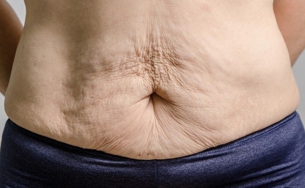 Căng da bụng và những thắc mắc thường gặp - Bệnh viện Thẩm mỹ Thu Cúc