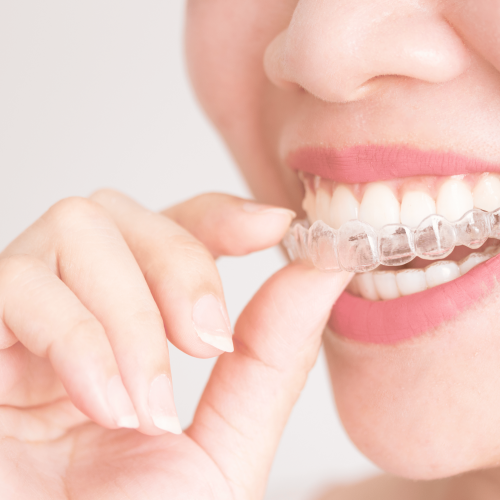 Aligners in Ajman | Certified Clear Aligner Provider
