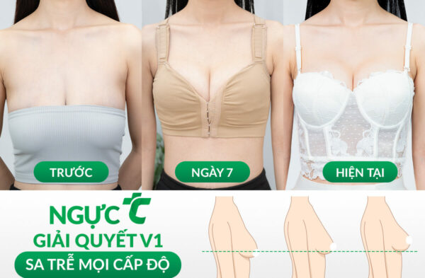 Phân biệt nâng ngực và treo ngực sa trễ - Bệnh viện Thẩm mỹ Thu Cúc