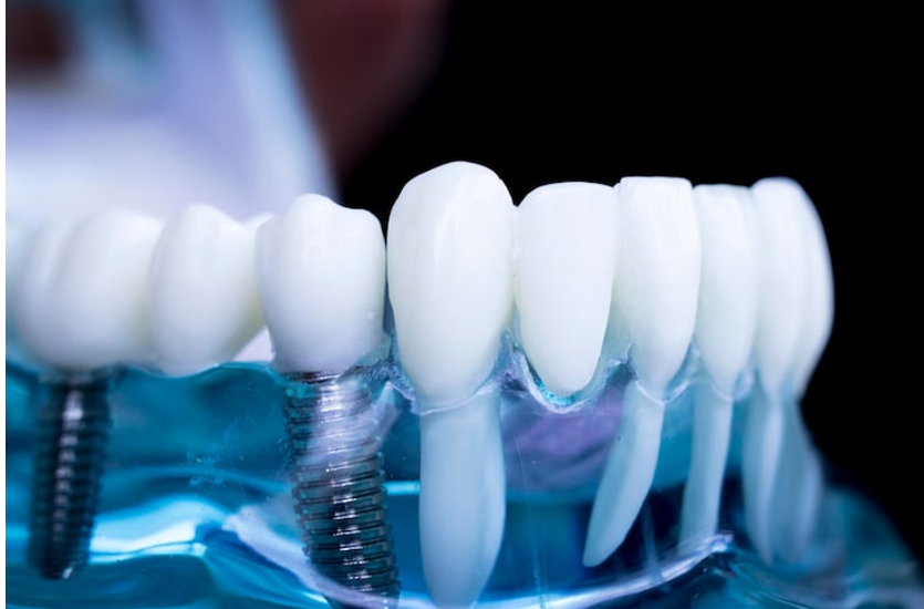 كم تكلفة زراعة الأسنان في أبوظبي؟ - Hollywood Smile Medical Center