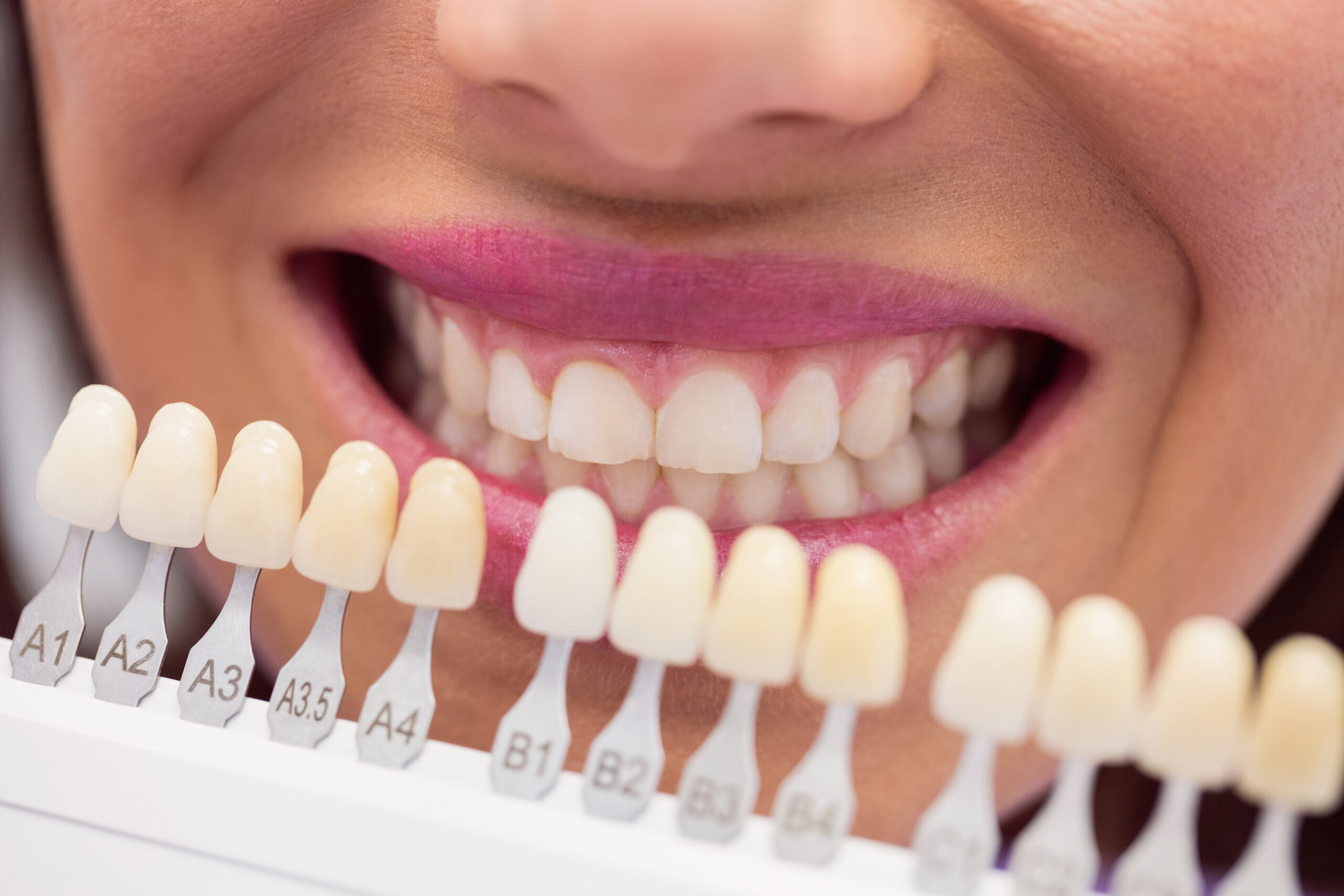 Veneers in Ajman | Best 3D Veneers for a Perfect Smile
