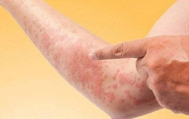 Dị Ứng Hải Sản Có Nguy Hiểm Không? Lời Khuyên Cho Người Dị Ứng Hải Sản – Newway - Thương hiệu uy tín hàng đầu trong lĩnh vực dược mỹ phẩm