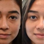 Ultimate Guide to Lower Eyelid Blepharoplasty in Cape Town - Tumblrblog