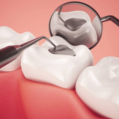 Filling in Ajman | Safe and Durable Tooth Fillings