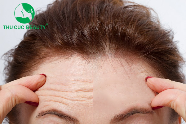 Xóa nhăn trán bằng botox bao nhiêu tiền? - Bệnh viện Thẩm mỹ Thu Cúc