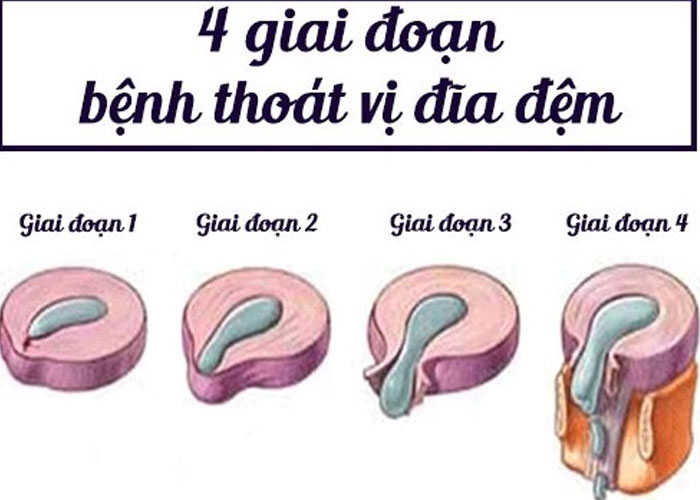 Phân độ thoát vị đĩa đệm và dấu hiệu nhận biết?
