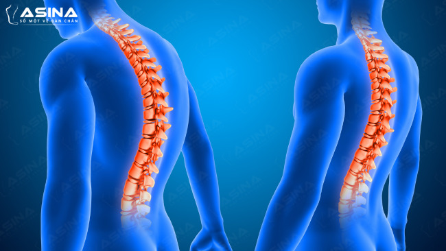 Vẹo cột sống là gì? Nguyên nhân, dấu hiệu và cách điều trị