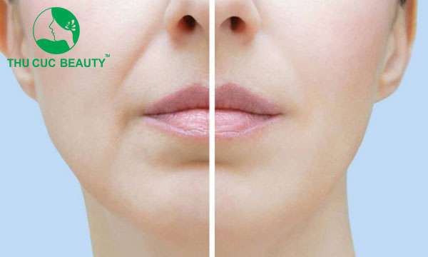 Tiêm filler rãnh cười bị sưng là làm sao?  - Bệnh viện Thẩm mỹ Thu Cúc